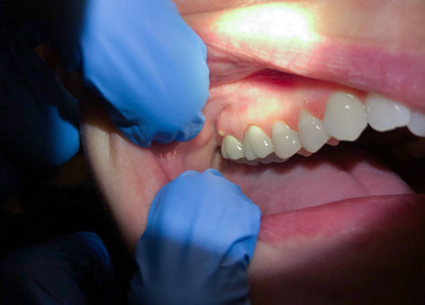 Best Chipped Tooth Repair Near Me  in Deerfield, IL